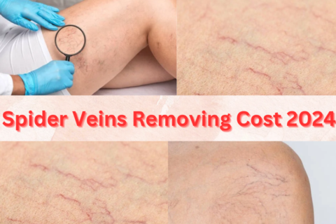 Spider Veins Removing Cost 2024