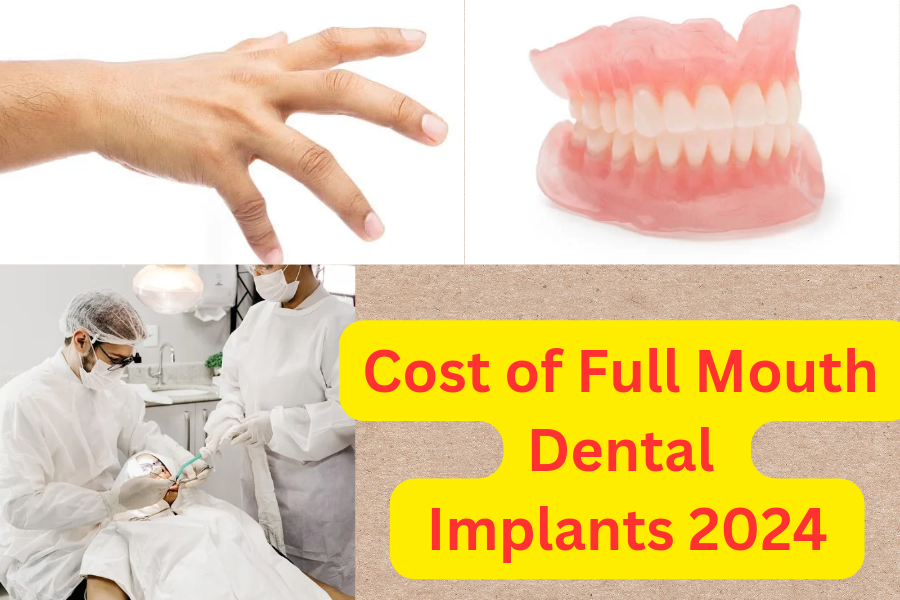 Cost of Full Mouth Implants 2024